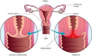 APS 015 : Cervicite Symptômes Causes Traitements et Remède Naturel Urétrite