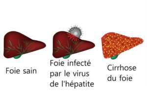 Remède 011 : Soin Naturel HEPATITE B, le Moringa sur le Foie pour Soigner l'Hépatite B