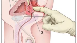 Comment Eviter la Prostate Remède naturel Les-différentes-techniques-de-prostatectomie toucher_rectal