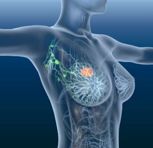 english-recurrent-breast-cancer Remède 043 : Cancer du Sein Symptômes et Solution Naturelle