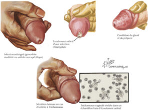 uretrite APS 03 : Urétrite Traitement Naturel Infections Urinaires