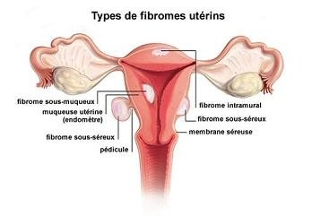 APS 018 : Remède Naturel Fibrome Utérin avec l’Ail Soin Naturel