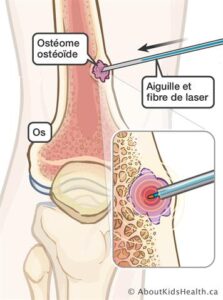 Os-tissus-vivant Remède 040 : L’ostéosarcome, Le Chondrosarcome, Le Sarcome d'Ewing Remède Naturel