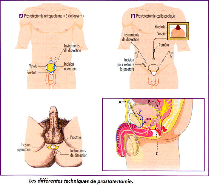 Comment Eviter la Prostate Remède naturel Les-différentes-techniques-de-prostatectomie