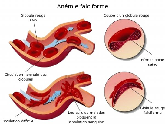 Découvrez le Traitement Naturel de la Drépanocytose sur Afrique Pharma Santé