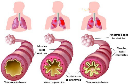 RECETTE 137 : Soigner asthme naturellement, Traitement naturel Asthme
