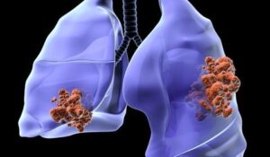 cancer-trait Cancer-du-poumon Remède 041 : Cancer du Poumon Remède Naturel