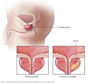 Cancer Prostate Solution Naturelle Par les Plantes. Remède naturel pour guerir la prostate sans intervention chirugicale. Voici la solution 
