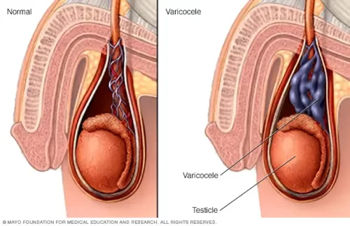 Guérir la Varicocèle avec un Traitement Naturel : Disponible sur Afrique Pharma Santé