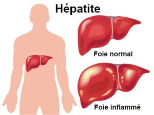 Combattez l'Hépatite B et C Naturellement : Notre Traitement sur AfriquePharmaSante.com