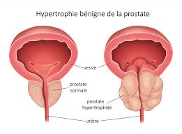 Comment Eviter la Prostate Remède naturel Les-différentes-techniques-de-prostatectomie toucher_rectal cancer-prostate