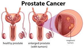 Comment Eviter la Prostate Remède naturel