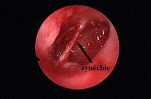 synechie- Comment soigner synéchies ?, Comment eviter les synéchies ?, Qui est tomber enceinte après une hystéroscopie ?, C'est quoi le syndrome d asherman ?,