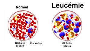 APS 015 : Leucémie Remède Naturel Anémie Causes Symptômes Traitement Naturel