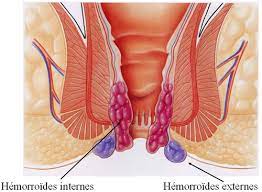 Hémorroïdes Traitement Naturel : Plantes Pour Guérir les Hémorroïdes