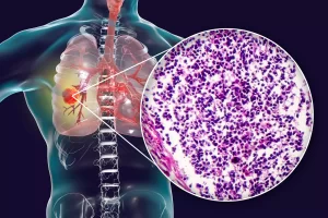 Cancer-du-poumon-un-diagnostic-souvent-trop-tardif Cancer-du-poumon-l-ibuprofene-protegerait-les-fumeurs Cancer du Poumon Cause Symptômes et Remède Naturel