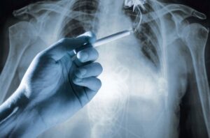 Cancer-du-poumon-un-diagnostic-souvent-trop-tardif Cancer-du-poumon-l-ibuprofene-protegerait-les-fumeurs Cancer du Poumon Cause Symptômes et Remède Naturel