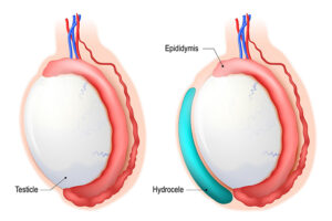 Comment Soigner l'Hydrocèle en Usa, Canada, Quebec