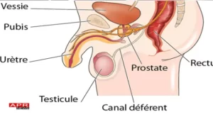 Cancer de la Prostate Traitement, Comment Eviter la Prostate Définitiement