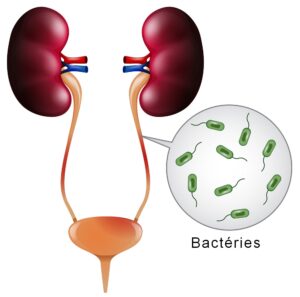 APS 116 : POUR GUÉRIR TOUTE FORME D'INFECTION URINAIRE