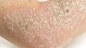Le mélanome cancer de la peau soin bio