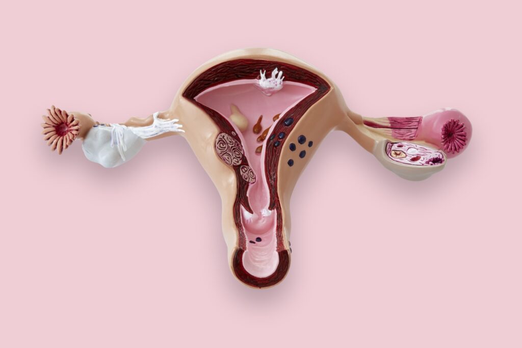 Comment Traiter la santé infertile féminine, Traitements naturels ?