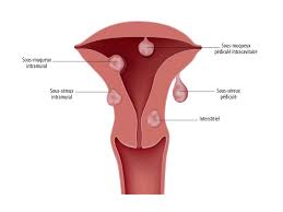 Comment changer la vie des femmes sur l'infertilité avec nos produits ?