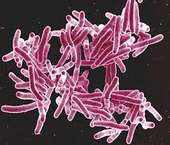 Comment Soigner la Tuberculose efficacement Remède Naturel
