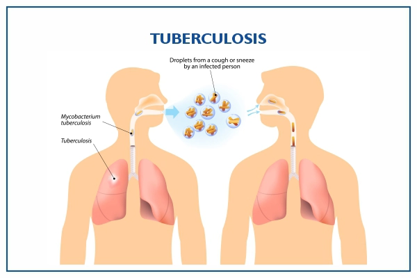 Contre la Tuberculose Symptômes causes et traitement naturel