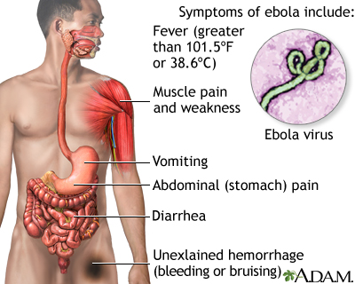 Traitement Naturel contre Ebola : Une Solution Disponible chez Afrique Pharma Santé