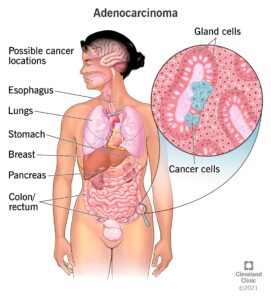 Luttez Contre le Cancer avec Afrique Pharma Santé