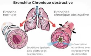 Les Maladies Respiratoires Soin naturel pour traiter les Maladies Respiratoires avec Afrique Pharma Santé