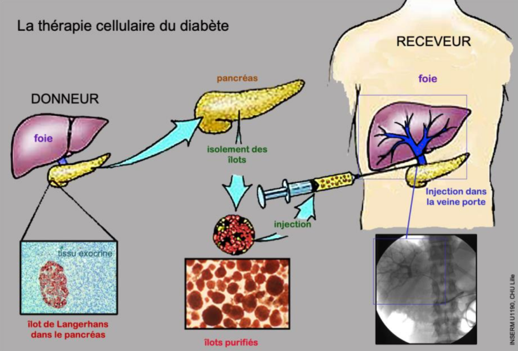 Traitement Naturel Contre le Diabète : Une Approche Holistique et Efficace