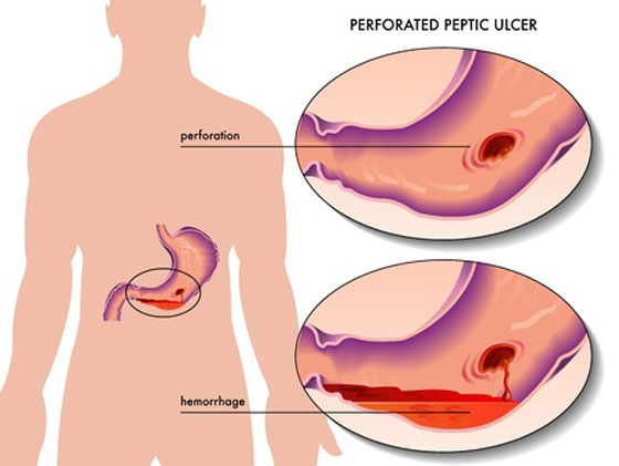 Traiter la Grippe la Gastro-entérite et la Bronchiolite Naturellement