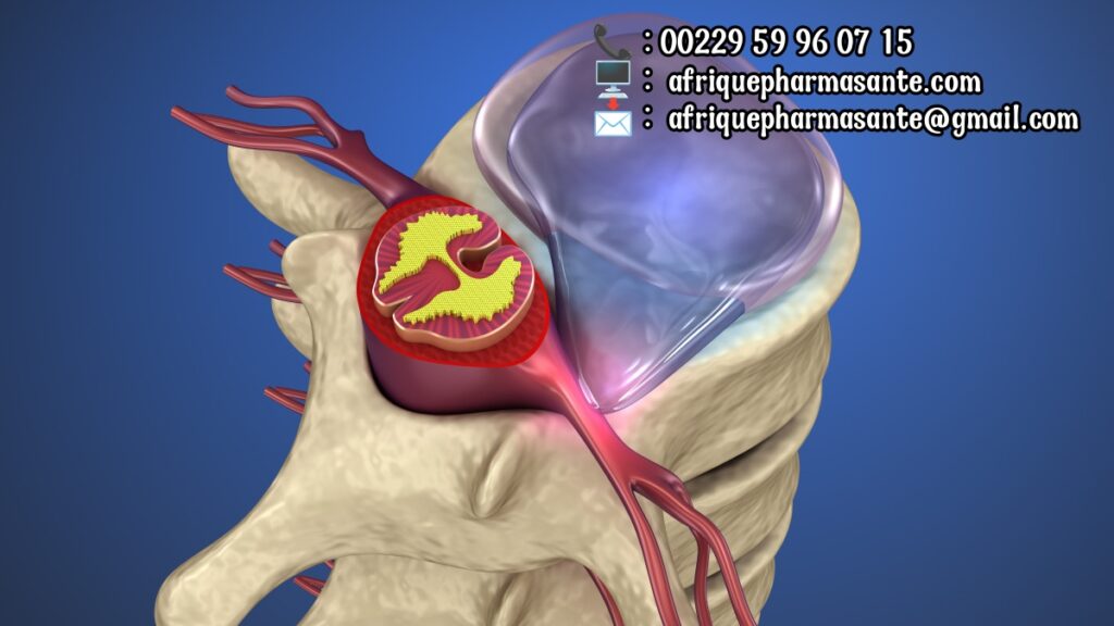 Guérir la Hernie Discale Traitements Naturels