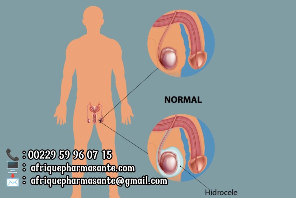Voici ce qu'il faut faire si vous souffrez de l'hydrocèle en Afrique