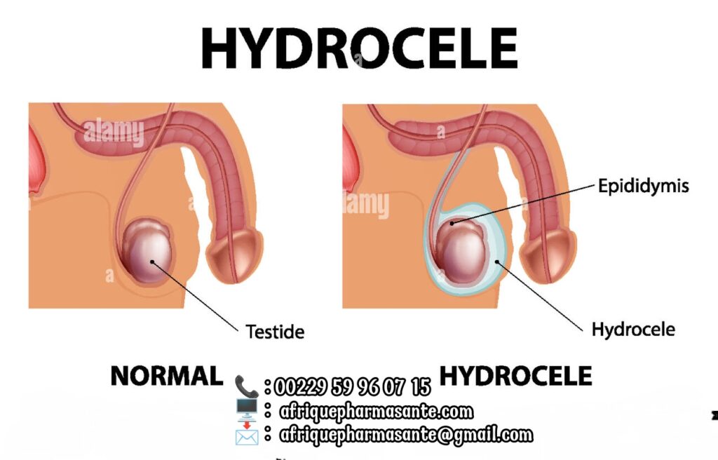 Comment Soigner l'Hydrocèle en Usa, Canada, Quebec