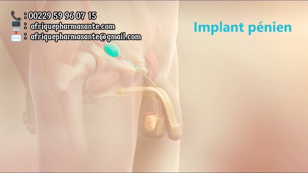 Comment soignger le Priapisme Traitement Naturel Pour Érection Permanente