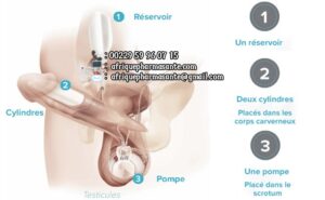 Remède 147 : Thérapie Prise en charge Priapisme Traitement Naturel pour Érection Permanente