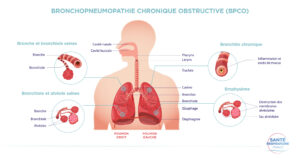 Comment traiter l'Asthme et la BPCO Remède naturel de l'asthme et la BPCO