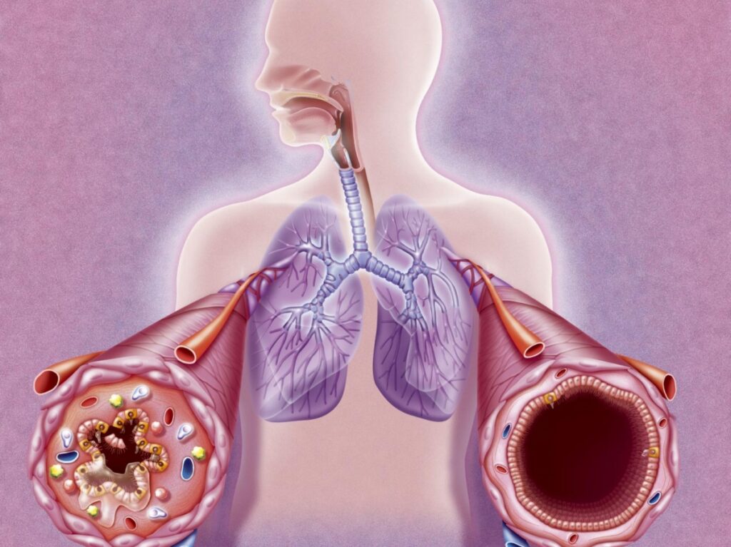 Comment soigner l'Asthme et la BPCO soin naturel de l'asthme et Respirer Profondément