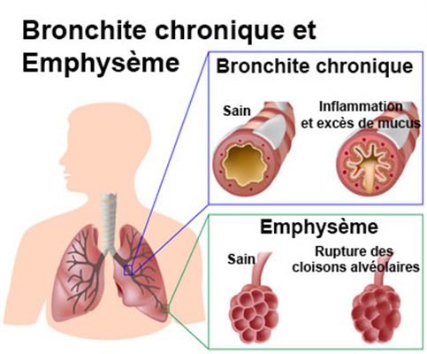 Les Maladies Respiratoires Soin naturel pour traiter les Maladies Respiratoires avec Afrique Pharma Santé