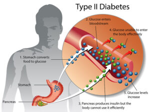 Voila Comment Guérir le Diabète de Type 2 Naturellement