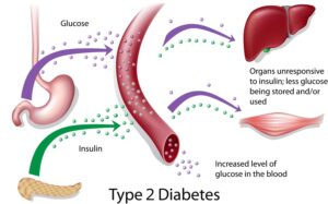 Contrôler le Diabète de Type 2 Solution Naturelle pour soigner le Diabète de Type 2