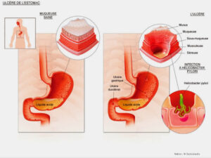 COMMENT SOIGNER L'ULCÈRE ET LES PLAIES INTERNES GRÂCE À DES SOLUTIONS NATURELLES
