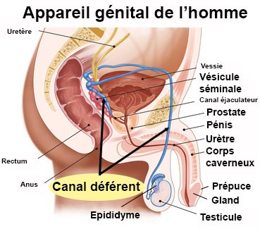 Spermatocèle Traitement naturel : Causes, Symptômes et Solutions Naturelles de la Spermatocèle