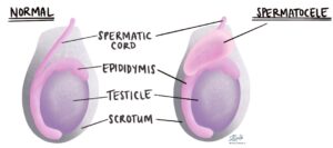 Comment Guérir le Spermatocele Naturellement Traitement naturel du spermatocèle 