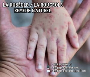 Comment guérir la Rubéole Traitement Naturel de la Rubéole