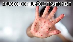 Comment se débarrasser de la rubéole? Traitement naturel Rubéole