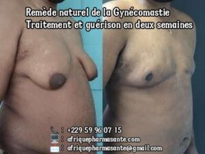 Découvrez le Remède Naturel pour la Gynécomastie : Guérison Définitive en 8 Semaines